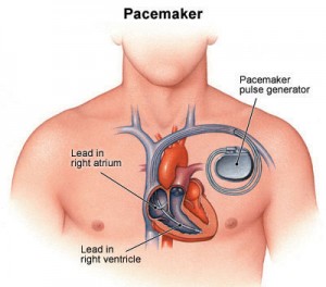 Dual chamber permanent pacemaker