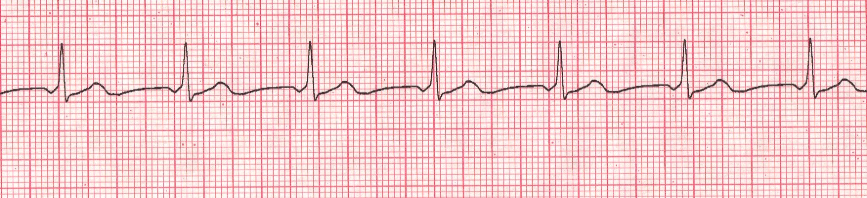 Junctional
