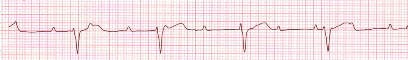 Third-degree-heart-block