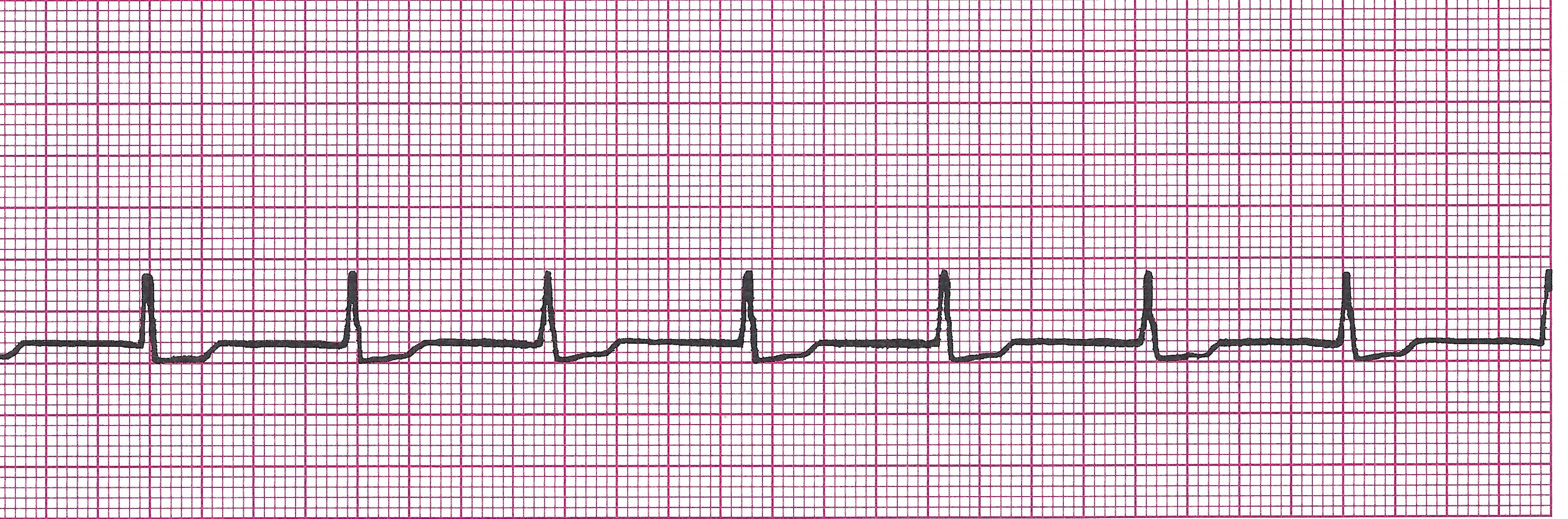 accelerated junctional 1 (6.8)