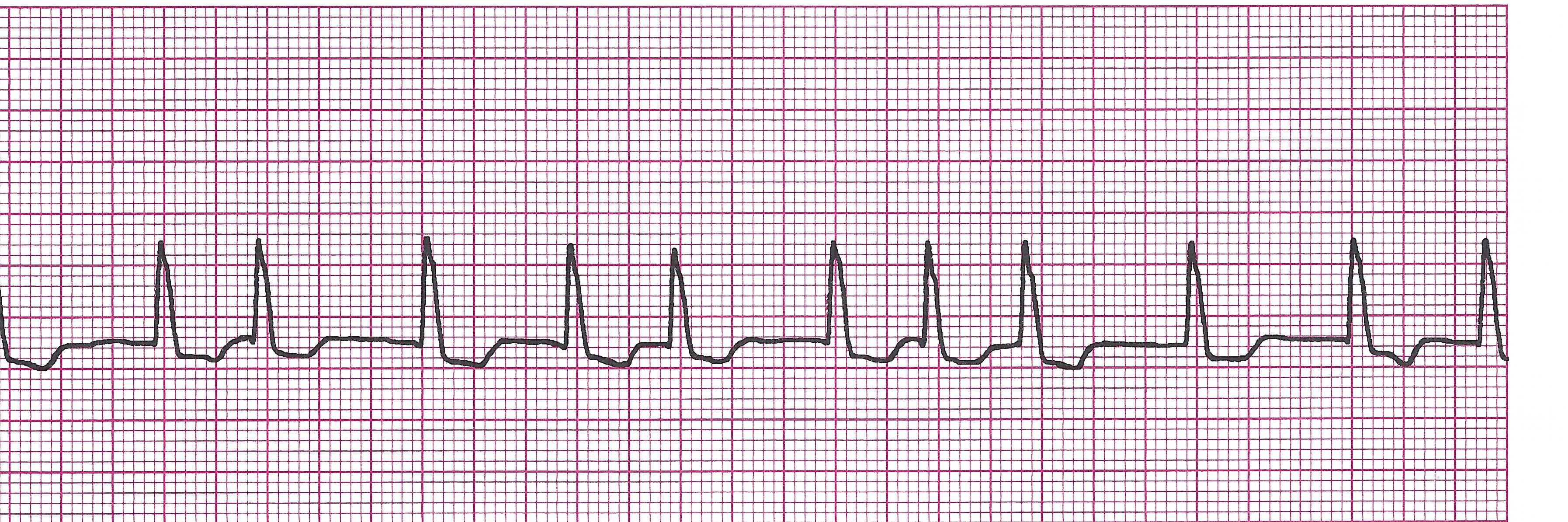 afib (5.29)