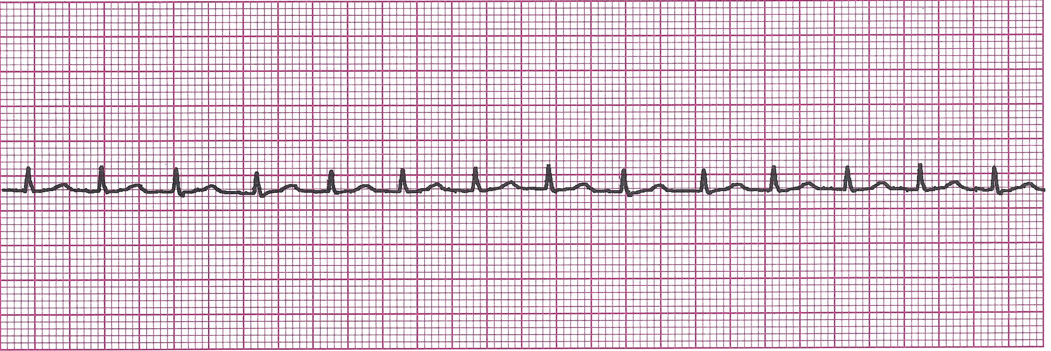 junctional tachycardia (6.17)