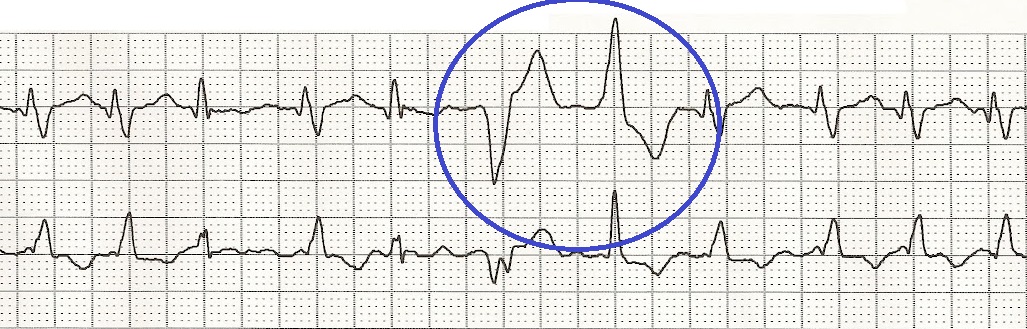 multifocal couplet