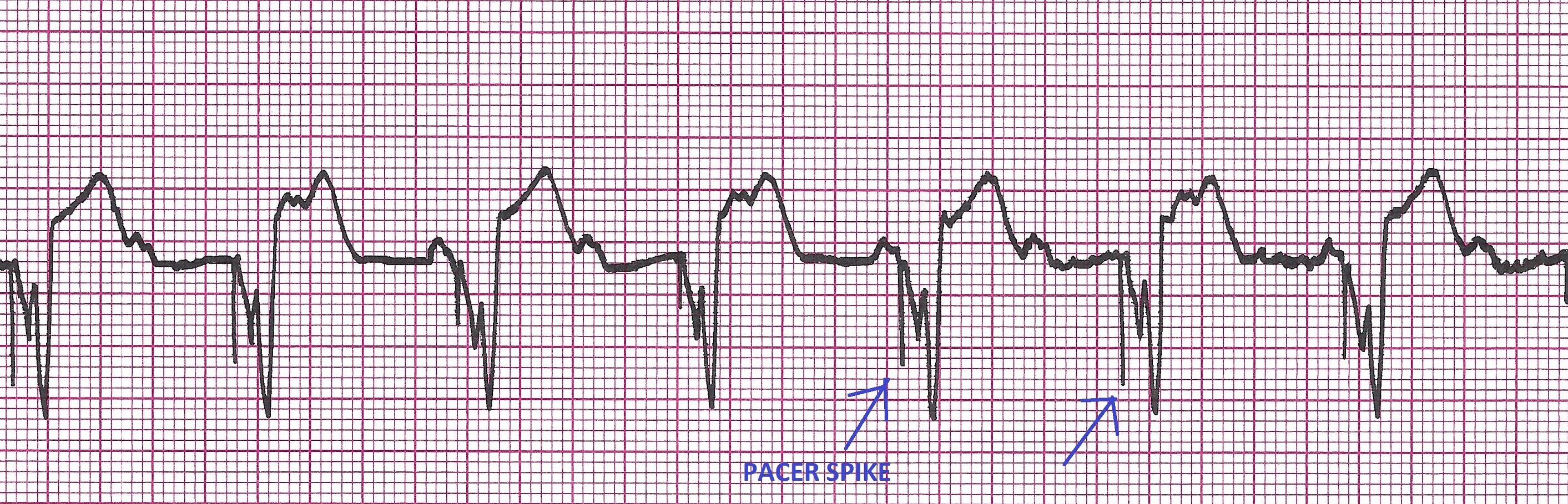 pacer spike example