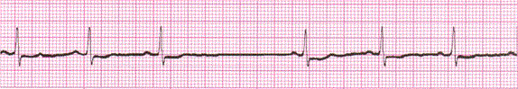 sinoatrial block