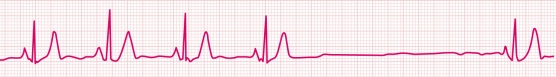 sinus arrest