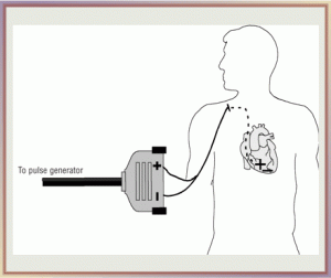 transvenous pacemaker 2