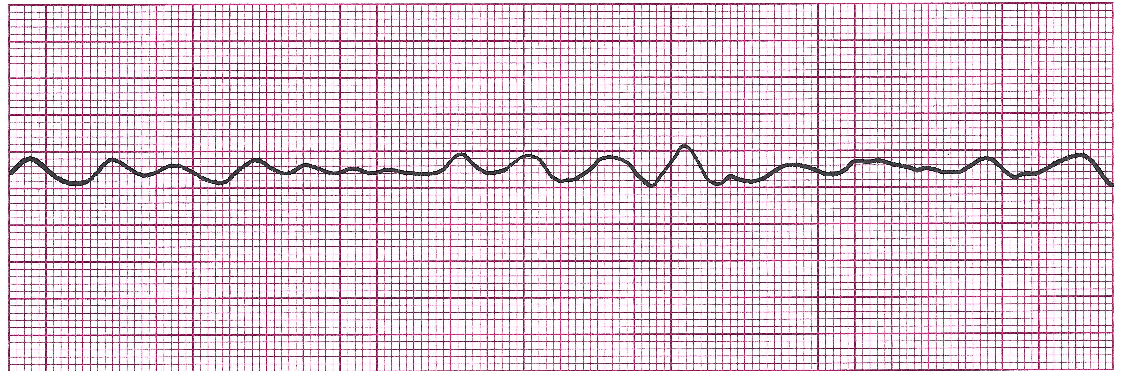 v fib 2